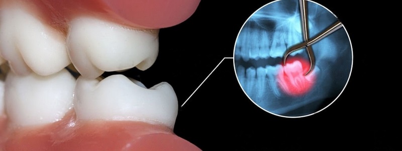 Benefits Of Wisdom Teeth Removal